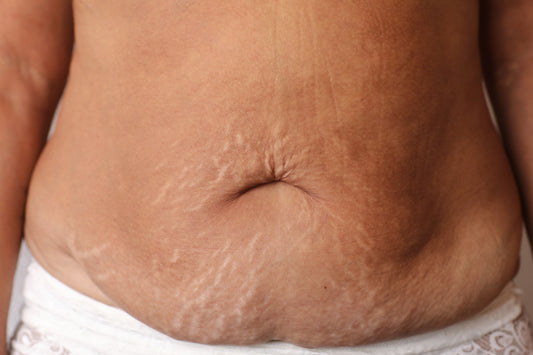 Mesotherapy for Stretch Mark Reduction-Premiumdermalmart.com