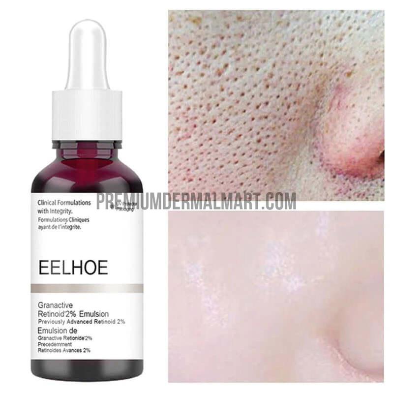 Anti Acne Exfoliating Face Serum