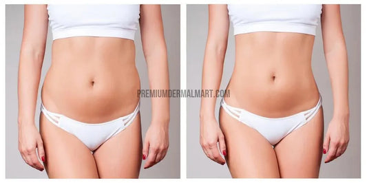 Navigating Body Contouring: Lipolysis vs. Surgical Fat Removal