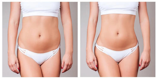 Navigating Body Contouring: Lipolysis vs. Surgical Fat Removal - premiumdermalmart.com