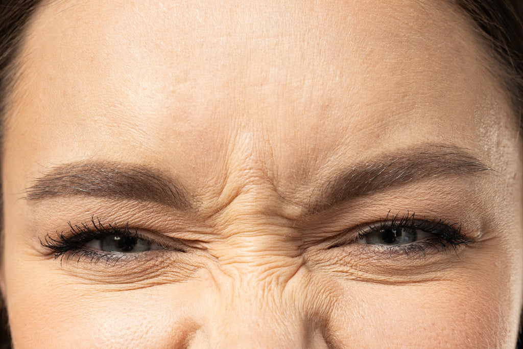 Dynamic Wrinkles and Expression Lines: A Guide to Botulinum Toxin