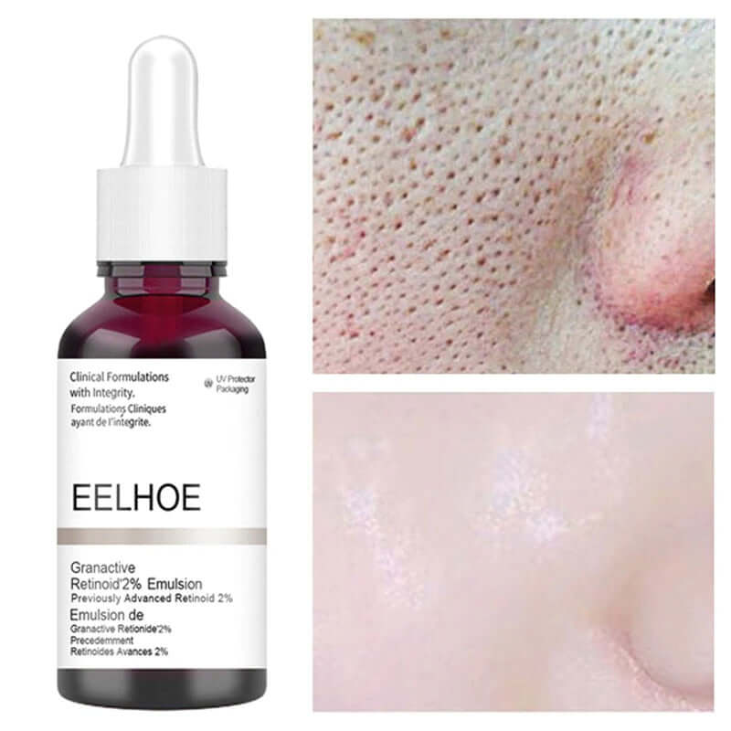 Anti Acne Exfoliating Face Serum Peeling Solution Pore Shrinking Face Skin Care Treatments serum - Premium Dermal Mart