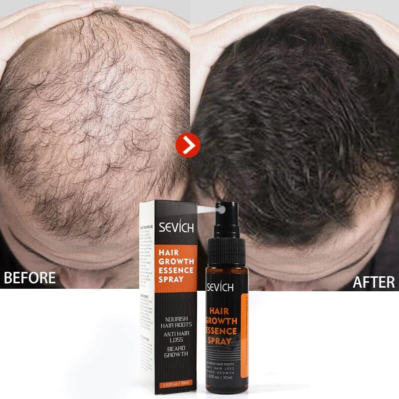 Natural hair loss treatment and Restoration - Premium Dermal Mart